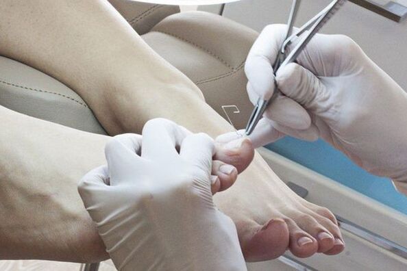 Mechanical removal of nails affected by fungus